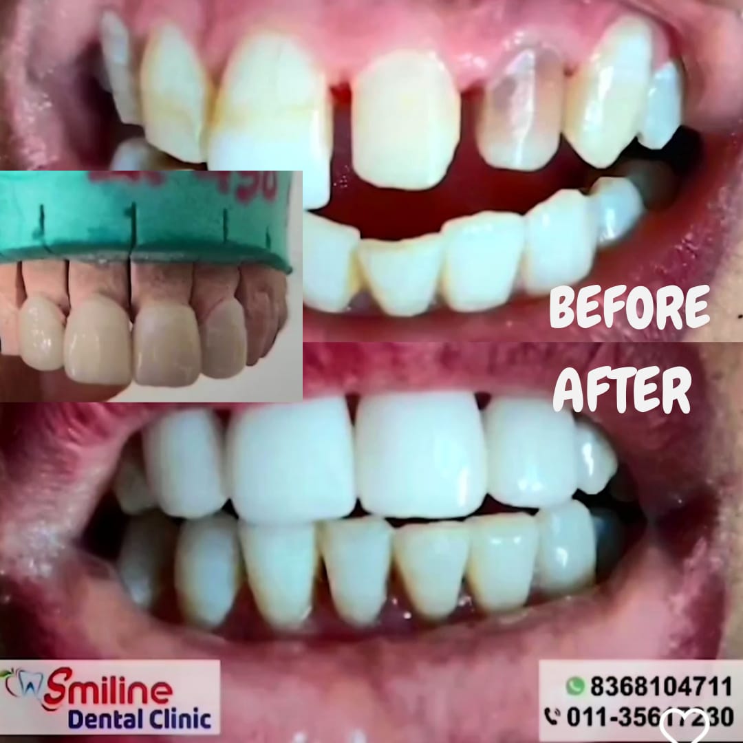 Dental veneers cosmetic dentistry at Smiline Dental Clinic Saket South Delhi